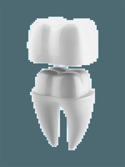 Dental Fillings, Crowns & Bridges in Arvada, CO.